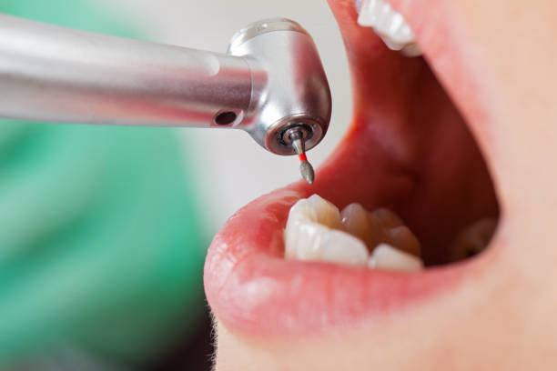 Best Emergency Tooth Extraction in Niwot, CO